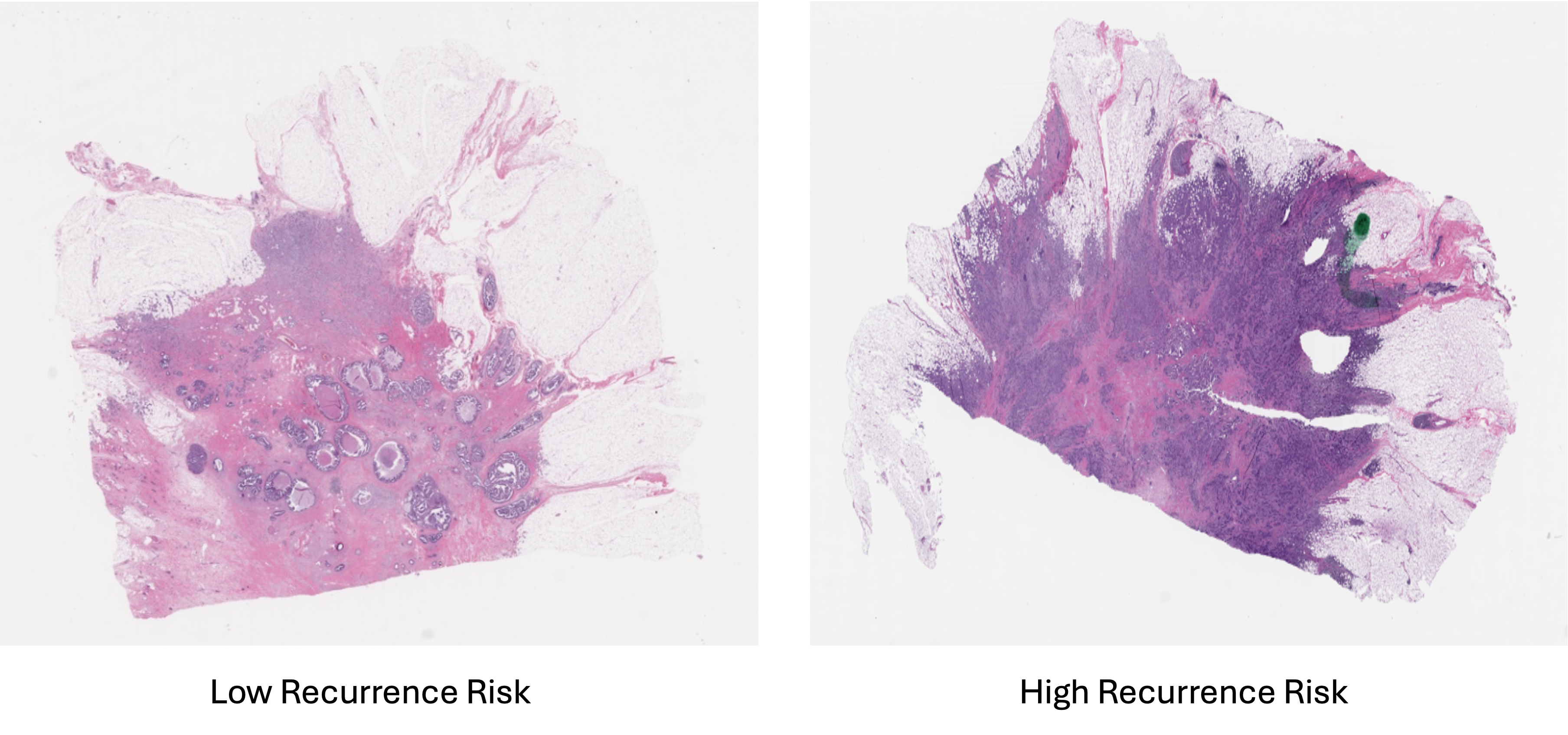 sample whole-slide images (breast cancer examples)